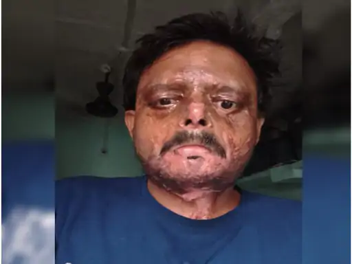 Gwalior Crime News: उधार के पैसे मांगने पर युवक को पेट्रोल डालकर जलाया, 4 महीने बाद दर्ज हुई FIR