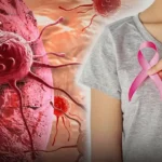 Breast Cancer Alert: 30 और 35 साल की महिलाओं ने गांठ को समझा सामान्य, इलाज के बाद मां बनने की उम्मीद