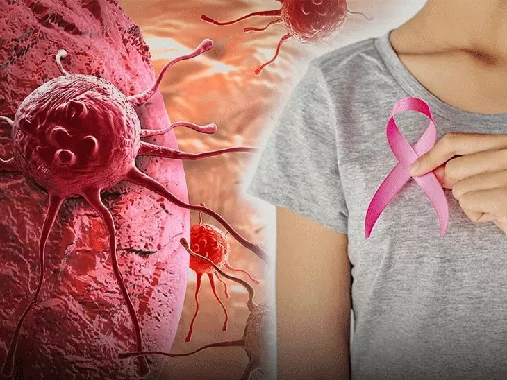 Breast Cancer Alert: 30 और 35 साल की महिलाओं ने गांठ को समझा सामान्य, इलाज के बाद मां बनने की उम्मीद