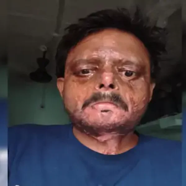 Gwalior Crime News: उधार के पैसे मांगने पर युवक को पेट्रोल डालकर जलाया, 4 महीने बाद दर्ज हुई FIR